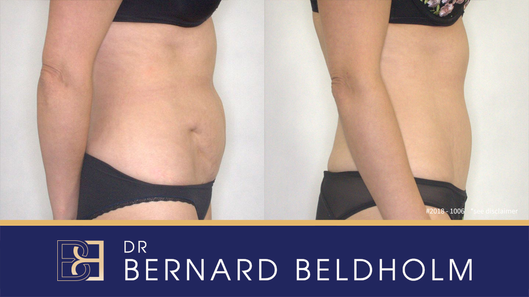 Mini Tummy Tuck (Abdominoplasty) is a much less invasive procedure than standard Tummy Tuck performed by Dr Beldholm