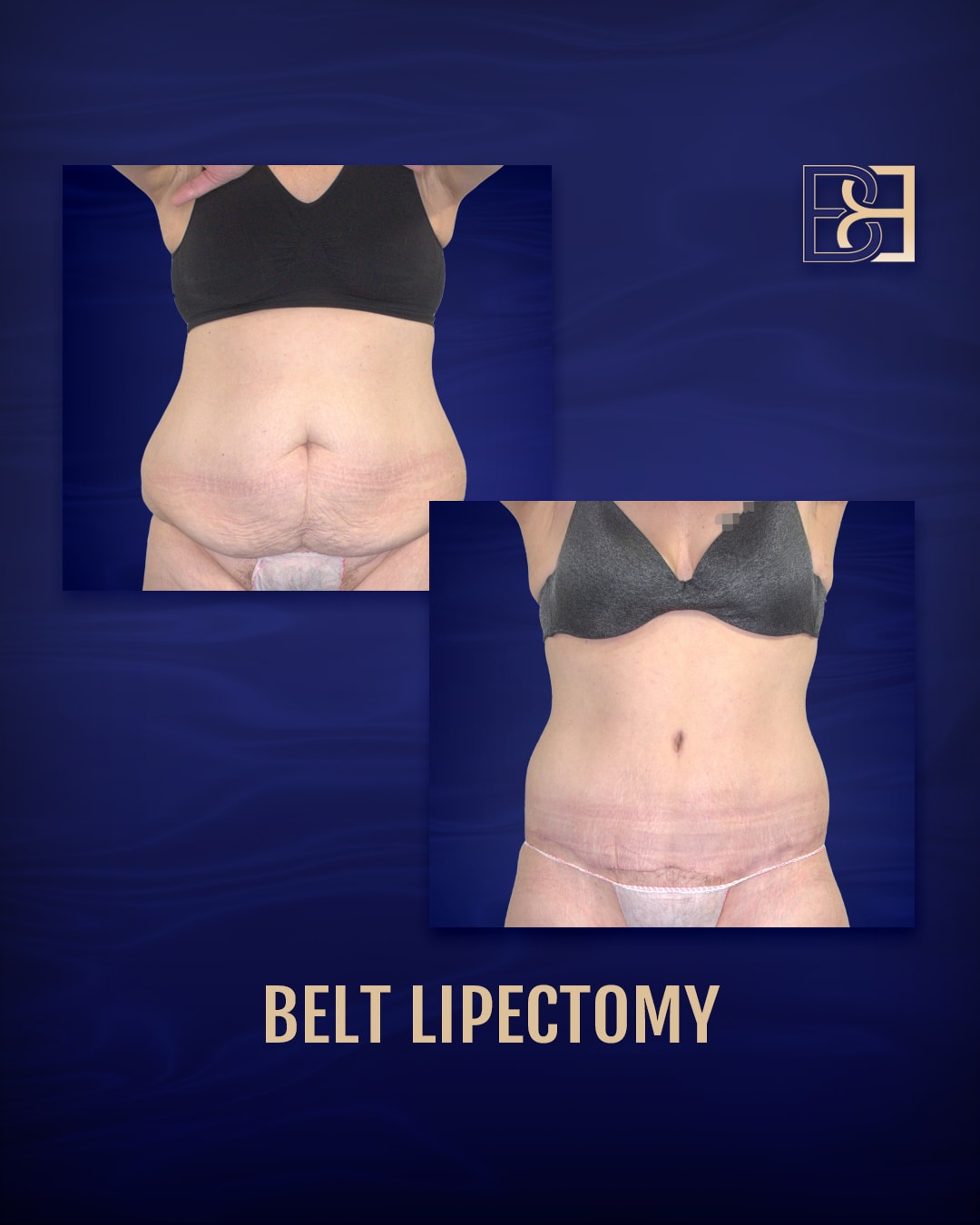 Belt lipectomy 2020-1024 | Before and after | beldholm.com.au