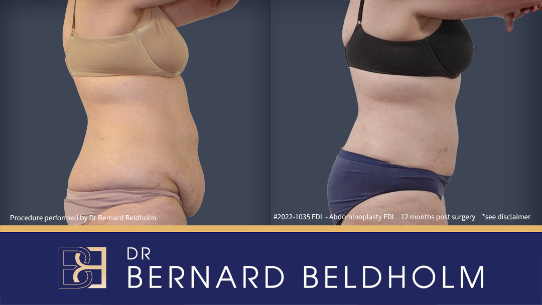 Tummy tuck (Abdominoplasty) after pregnancy performed by Dr Beldholm