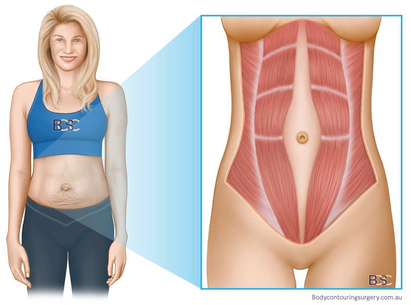 Diastasis Recti illustration by Dr Beldholm