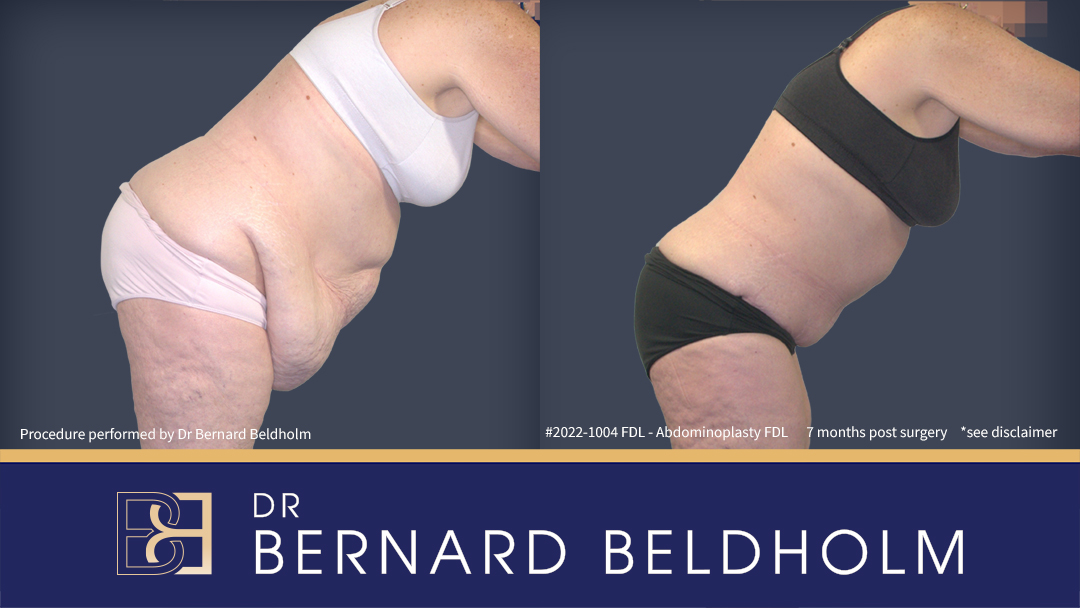 Adult patients before and after FDL abdominoplasty