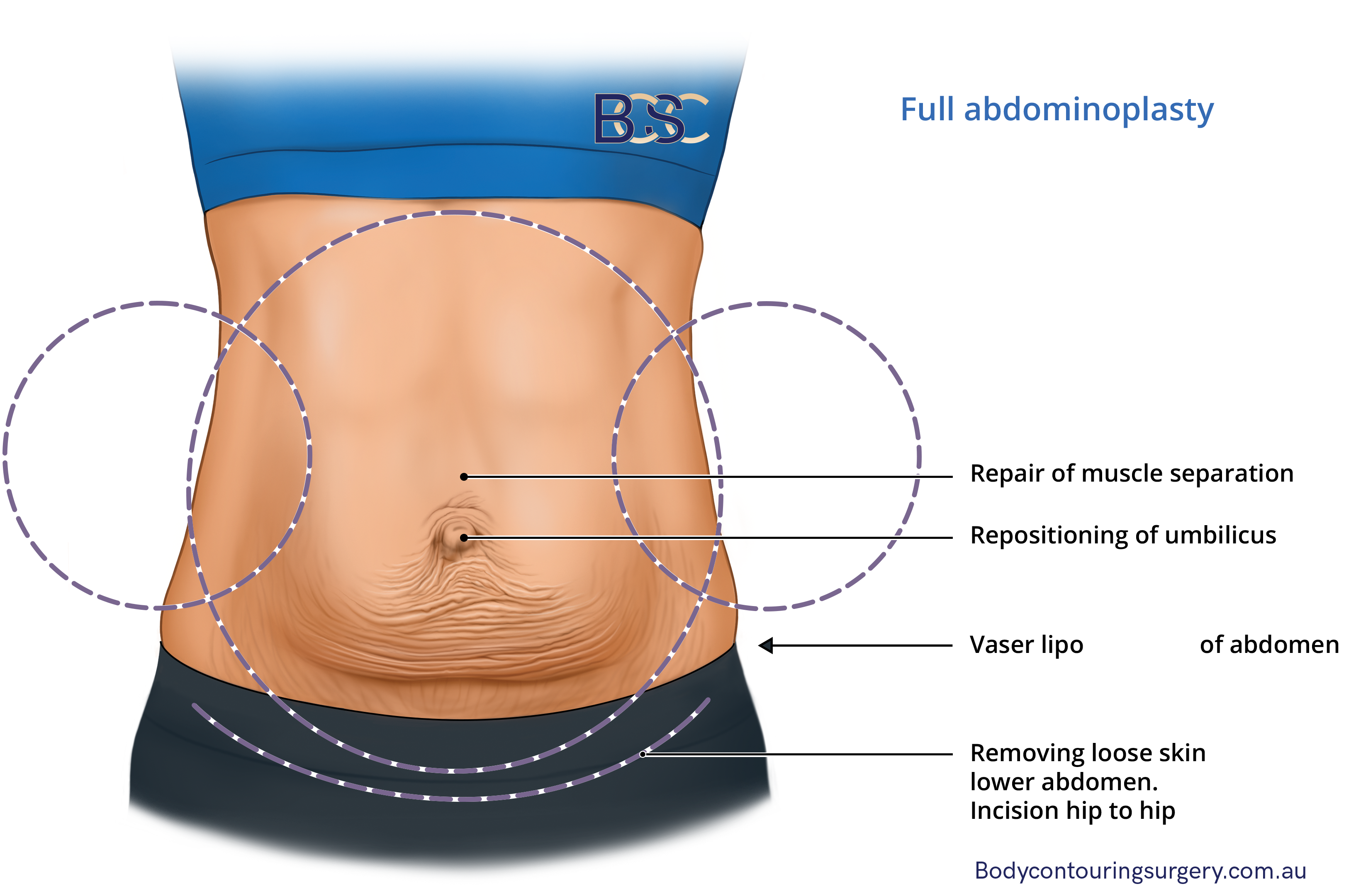 Full abdominoplasty illustration by Dr Beldholm