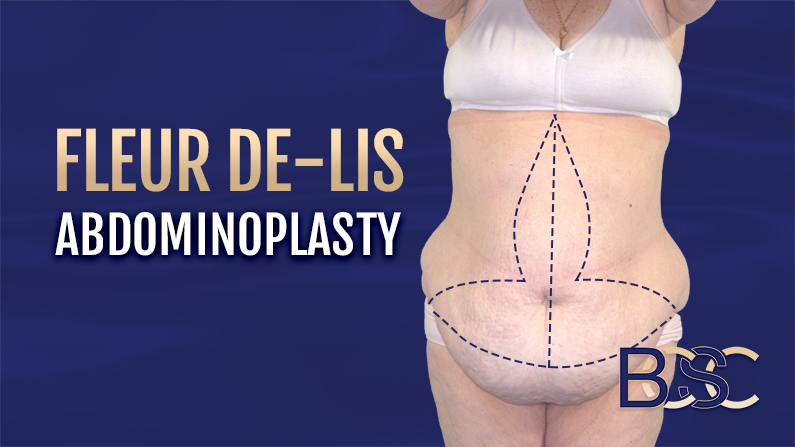 Illustration of fleur de lis abdominoplasty