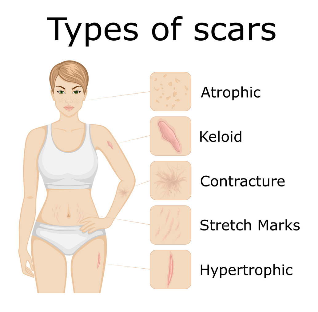 scar treatments for healing scar