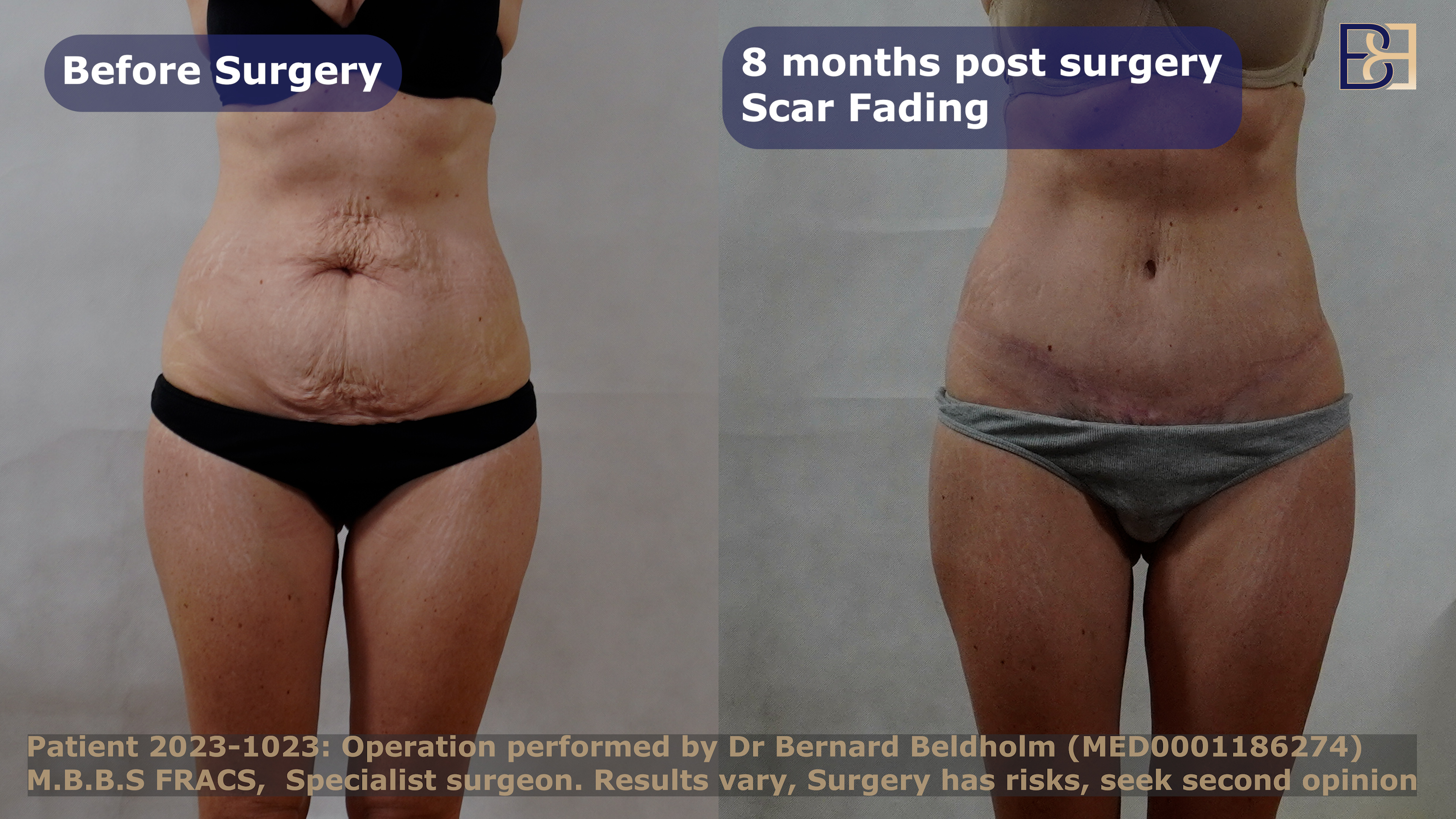 8 months post abdominoplasty scar fading | Dr Beldholm