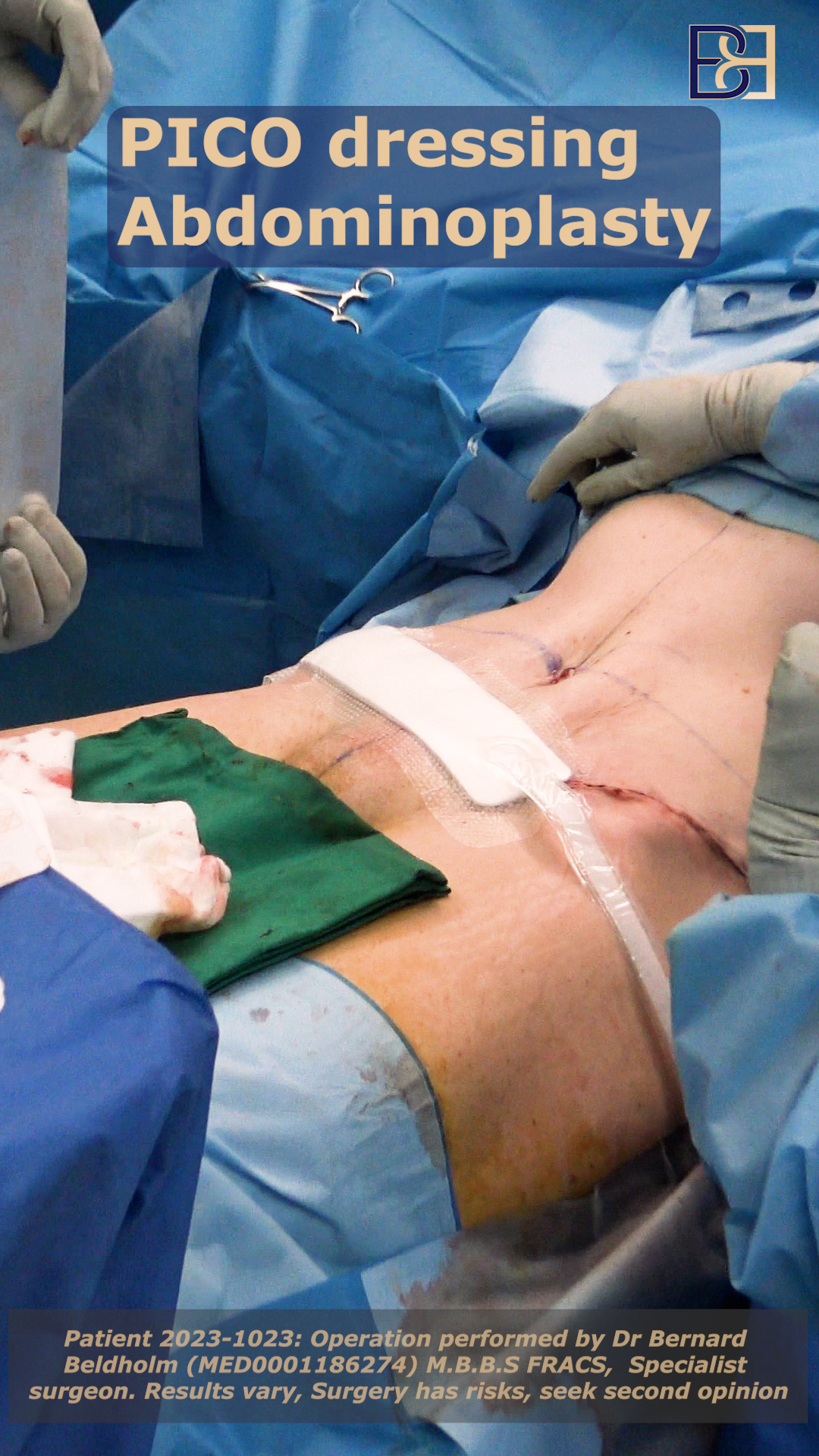 Dr Beldholm applies PICO dressing at the end of an abdominoplasty