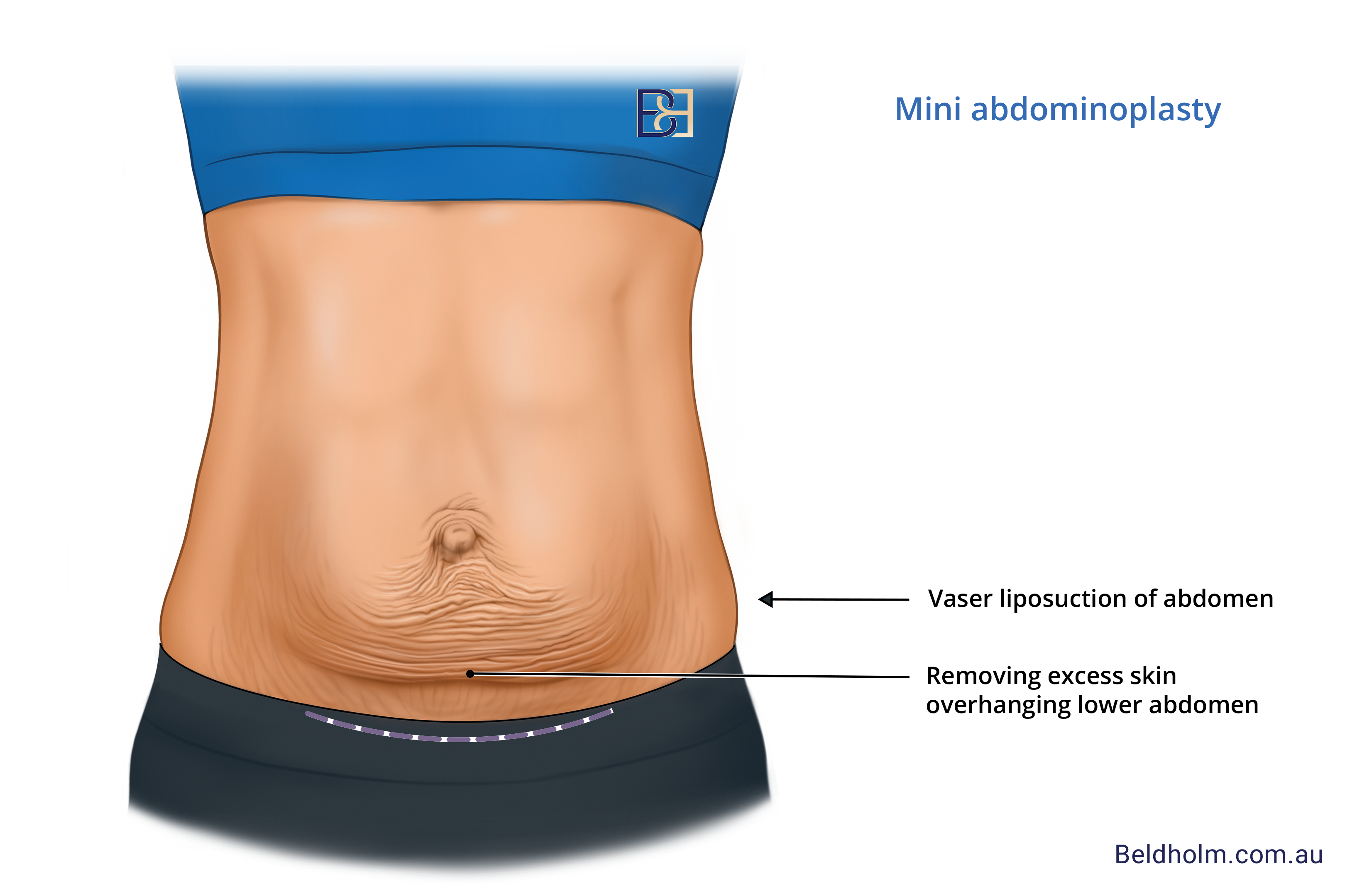 mini abdominoplasty illustration | Dr Bernard Beldholm