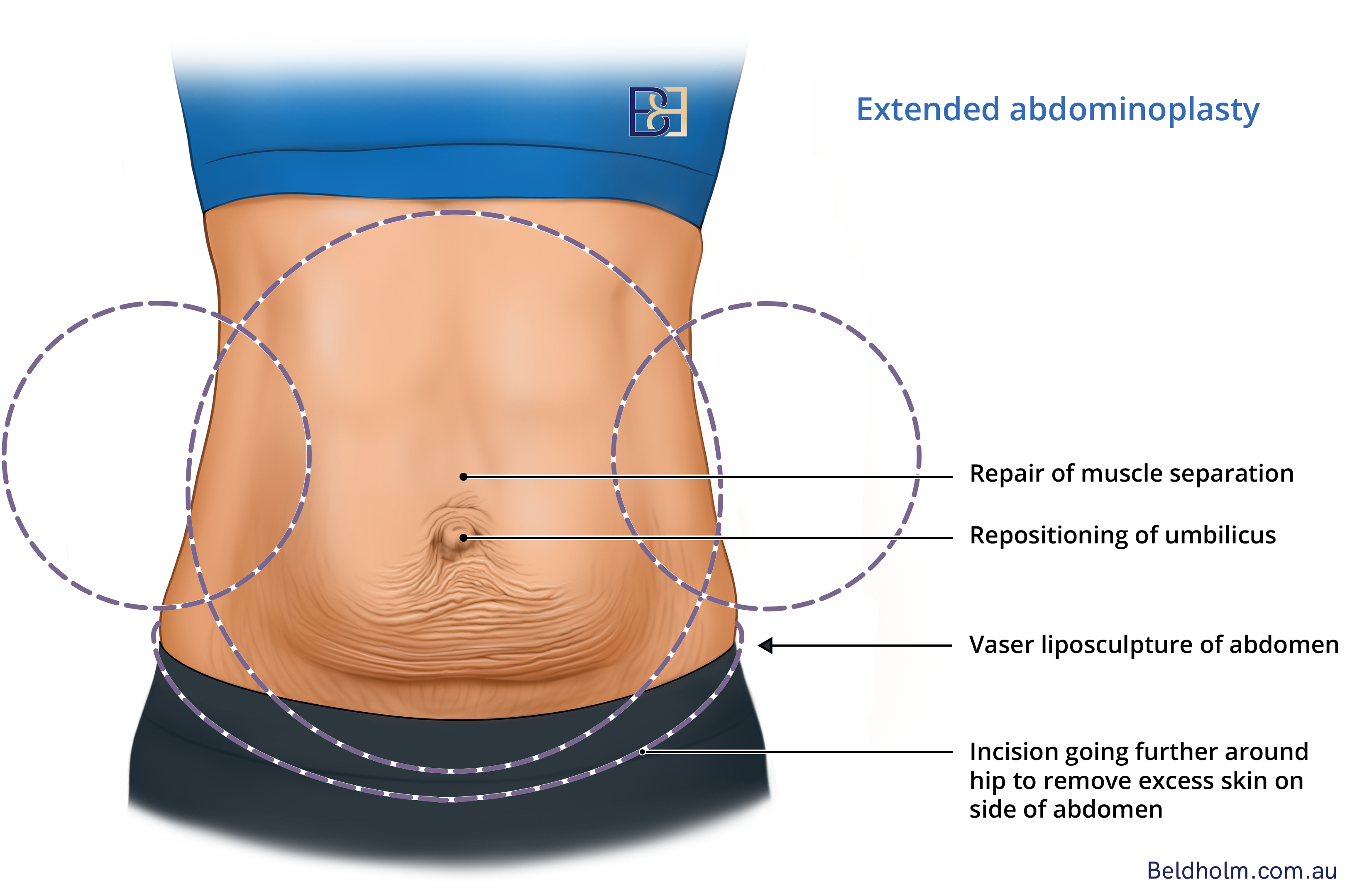 Extended abdominoplasty illustration | Dr Bernard Beldholm