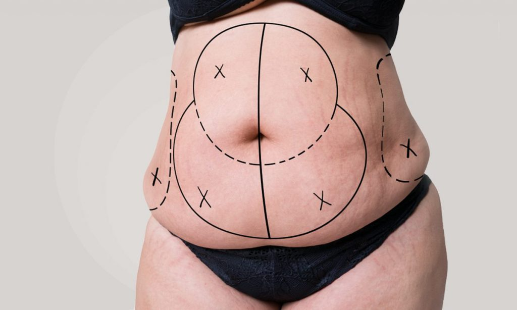 Abdominal markings | Dr Bernard Beldholm