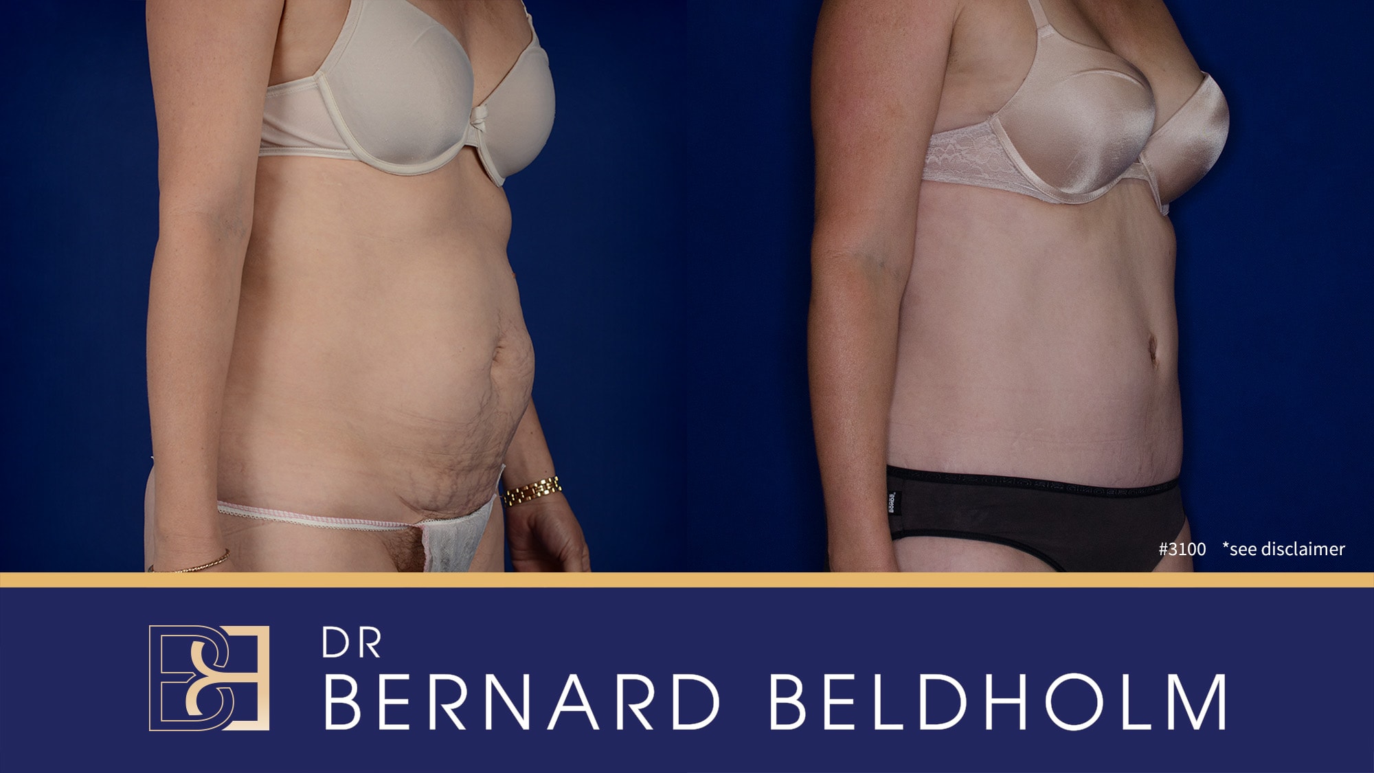 Before and after for full abdominoplasty performed by Dr Bernard Beldholm