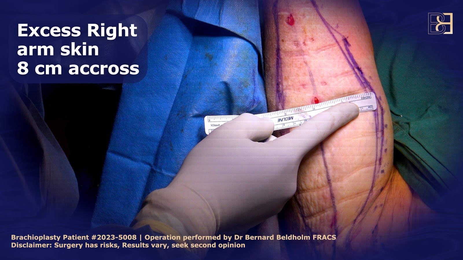 Measuring excess skin on right arm after liposuction has been performed | Dr Bernard Beldholm