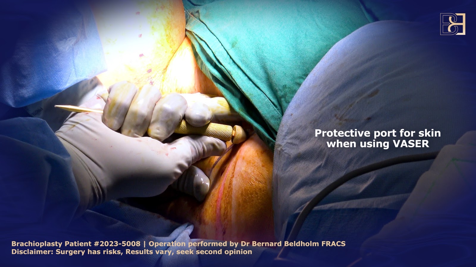Protective port inserted prior to VASER liposuction | Dr Bernard Beldholm