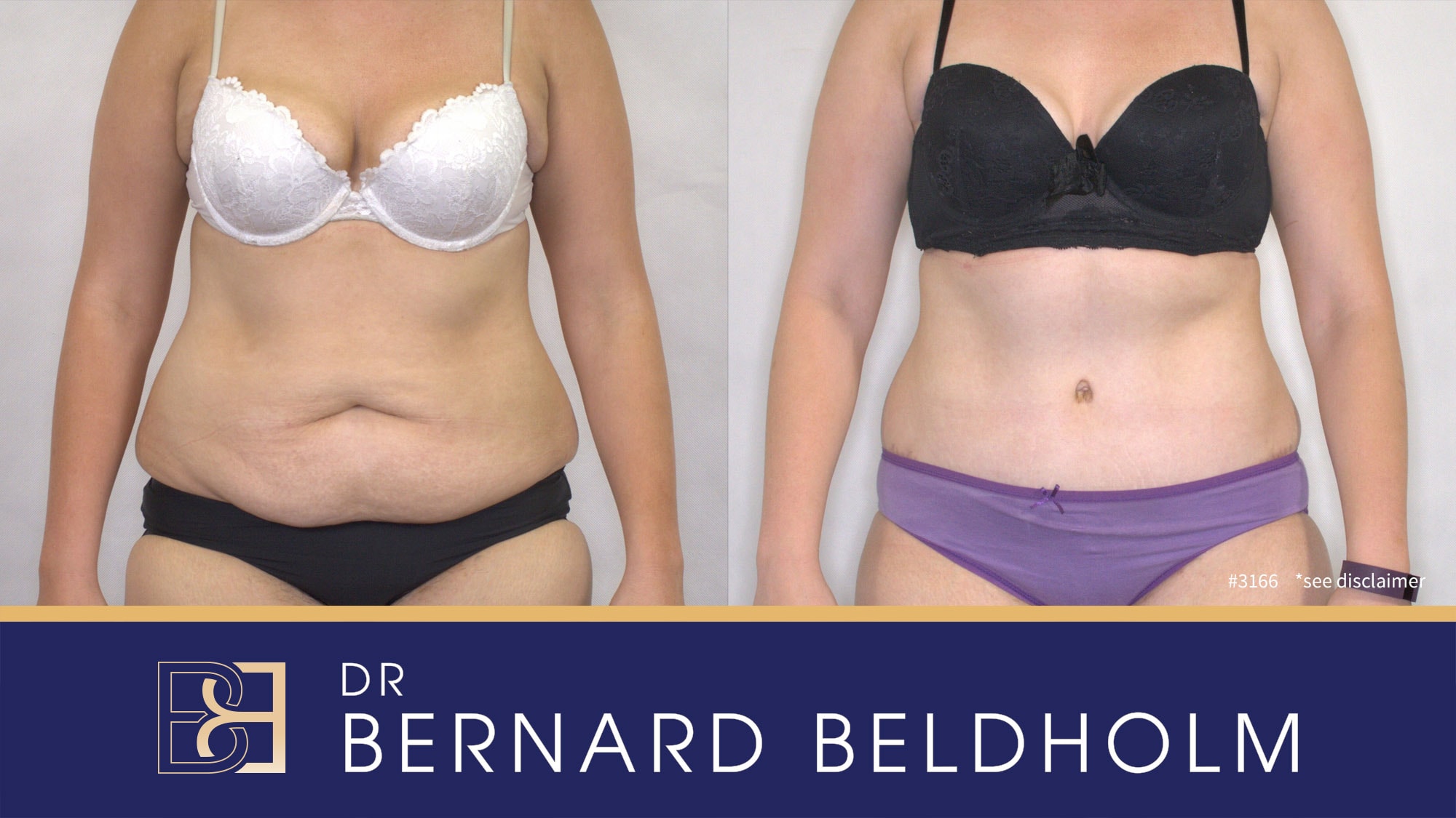 Abdominoplasty with VASER liposuction performed by Dr Bernard Beldholm