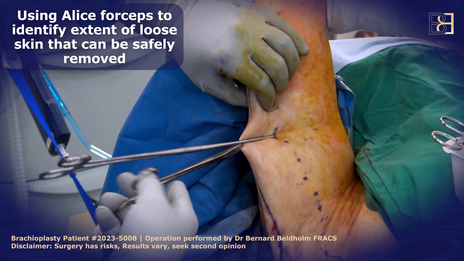 Identifying excess skin in Arm lift surgery | Dr Bernard Beldholm