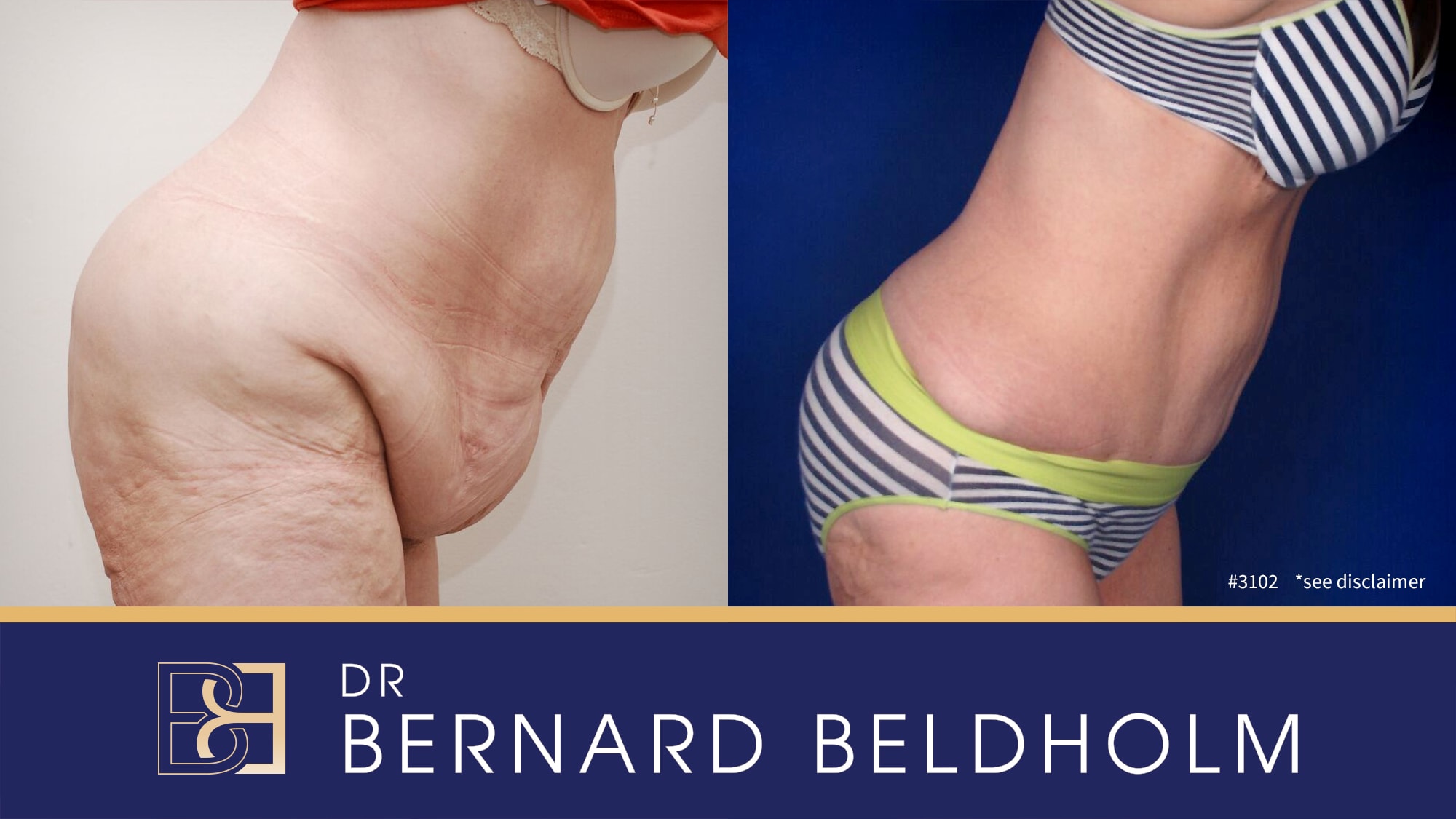 Extended abdominoplasty post weight loss performed by Dr Bernard Beldholm