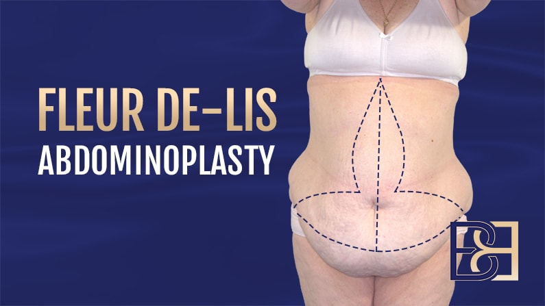 Fleur de lis abdominoplasty illustration | Dr Bernard Beldholm