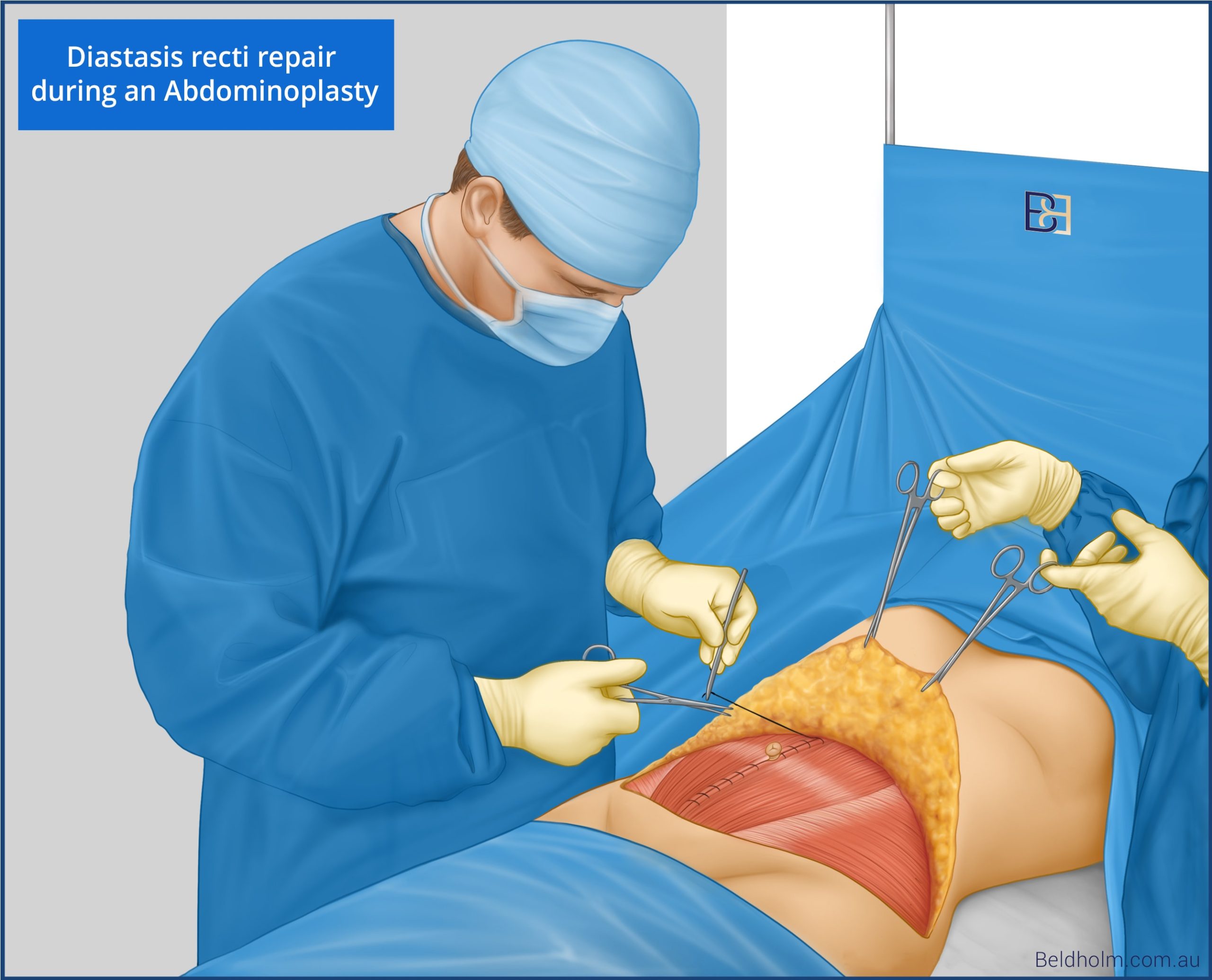 Diastasis recti repair illustration | Dr Bernard Beldholm