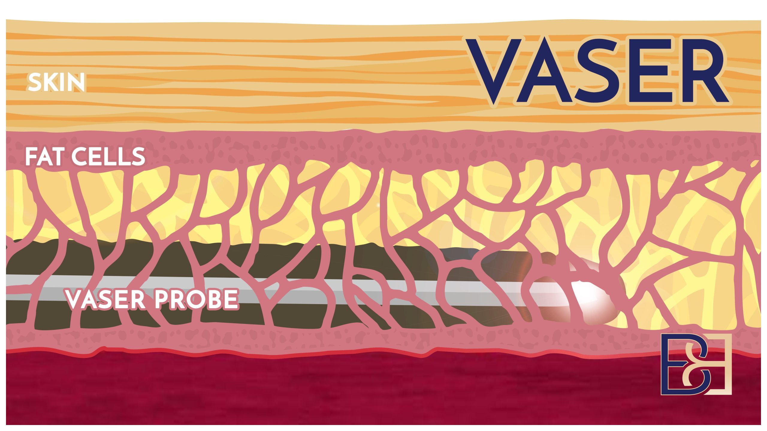 VASER liposuction illustration | Dr Bernard Beldholm