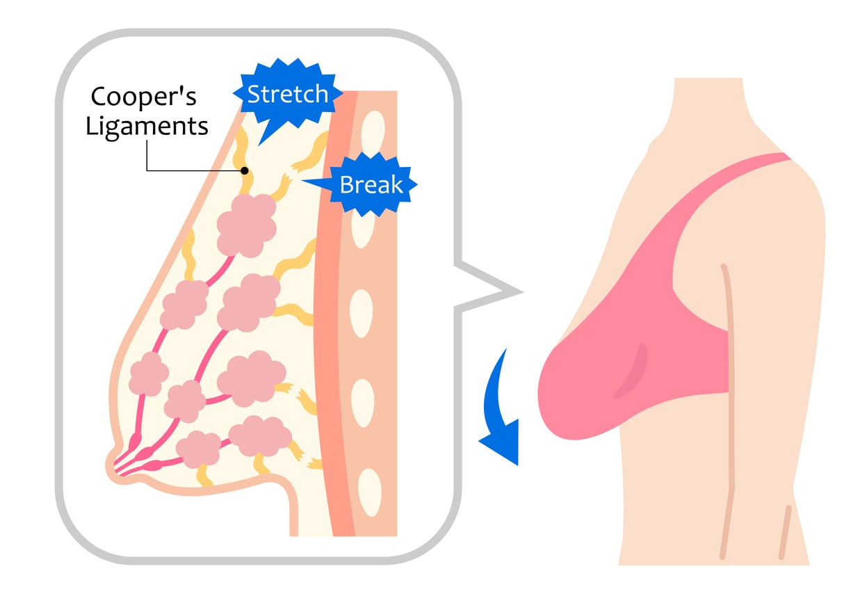 Breast ptosis illustration | Dr Bernard Beldholm