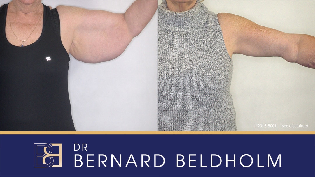 Brachioplasty Before and After mini | Dr Bernard Beldholm