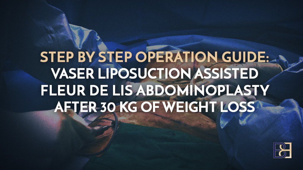 Step-by-Step Operation Guide: Vaser Assisted Fleur De Lis Abdominoplasty Surgery After 30 kg of Weight Loss