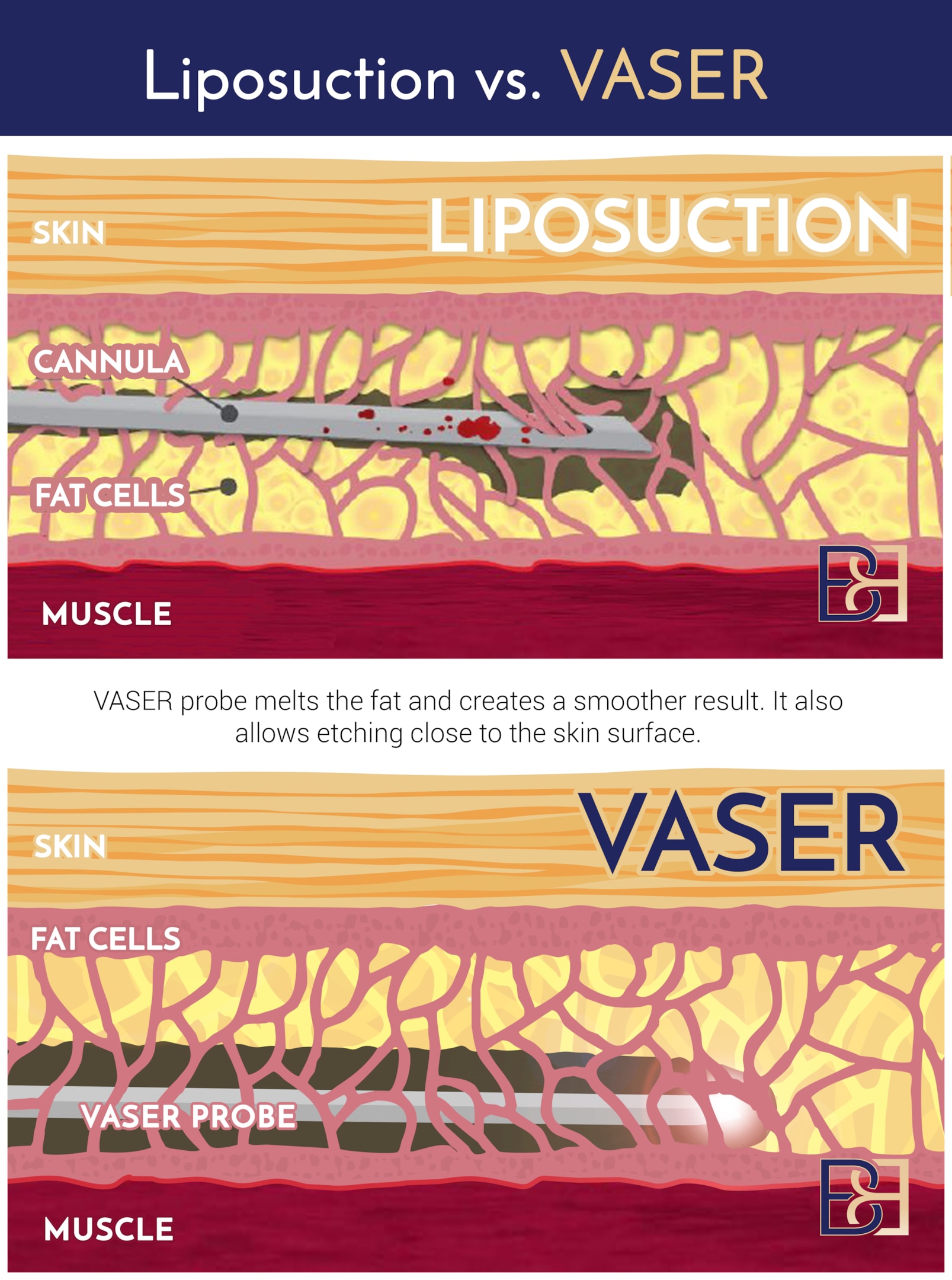 Liposuction vs VASER illustration | Dr Bernard Beldholm