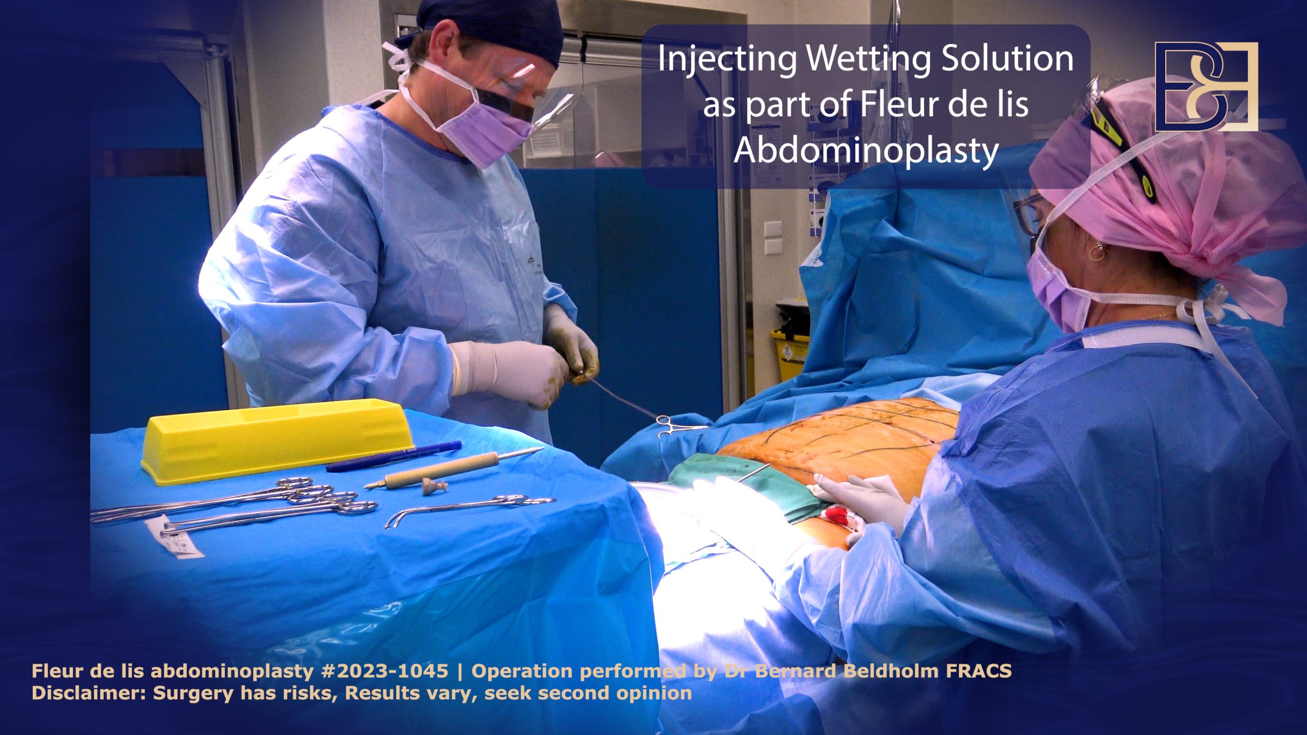 Dr Beldholm injecting wetting solution prior to liposuction