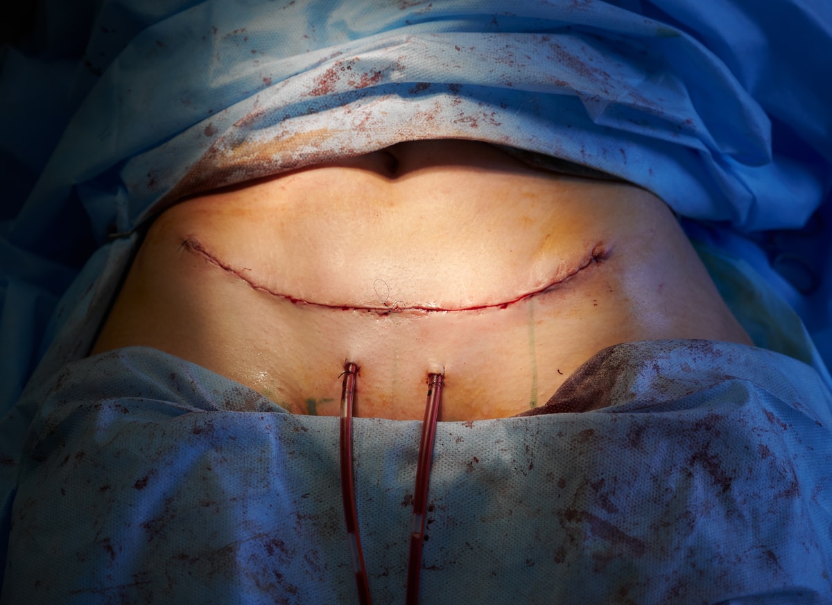 Surgical drains in an abdominoplasty