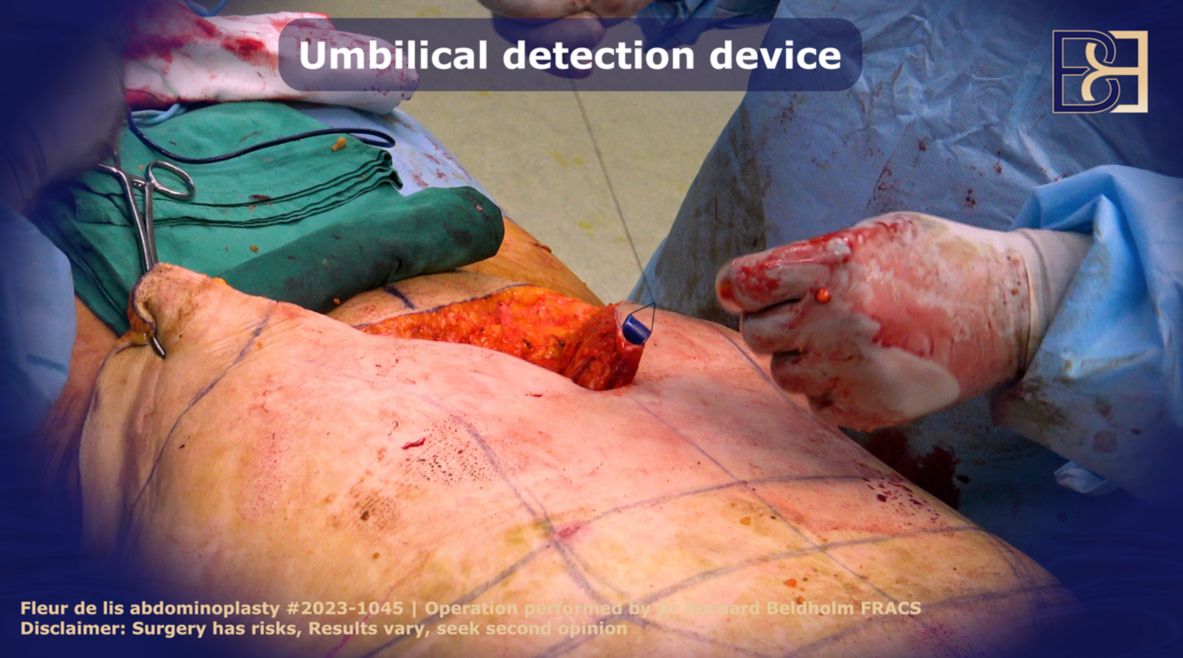 Umbilical cord detection device  | surgery performed  by Dr Bernard Beldholm