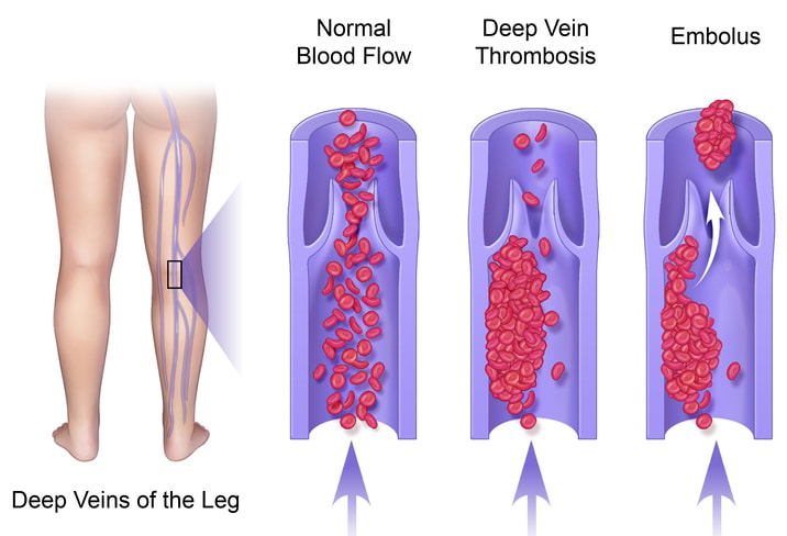 Deep Vein Thrombosis