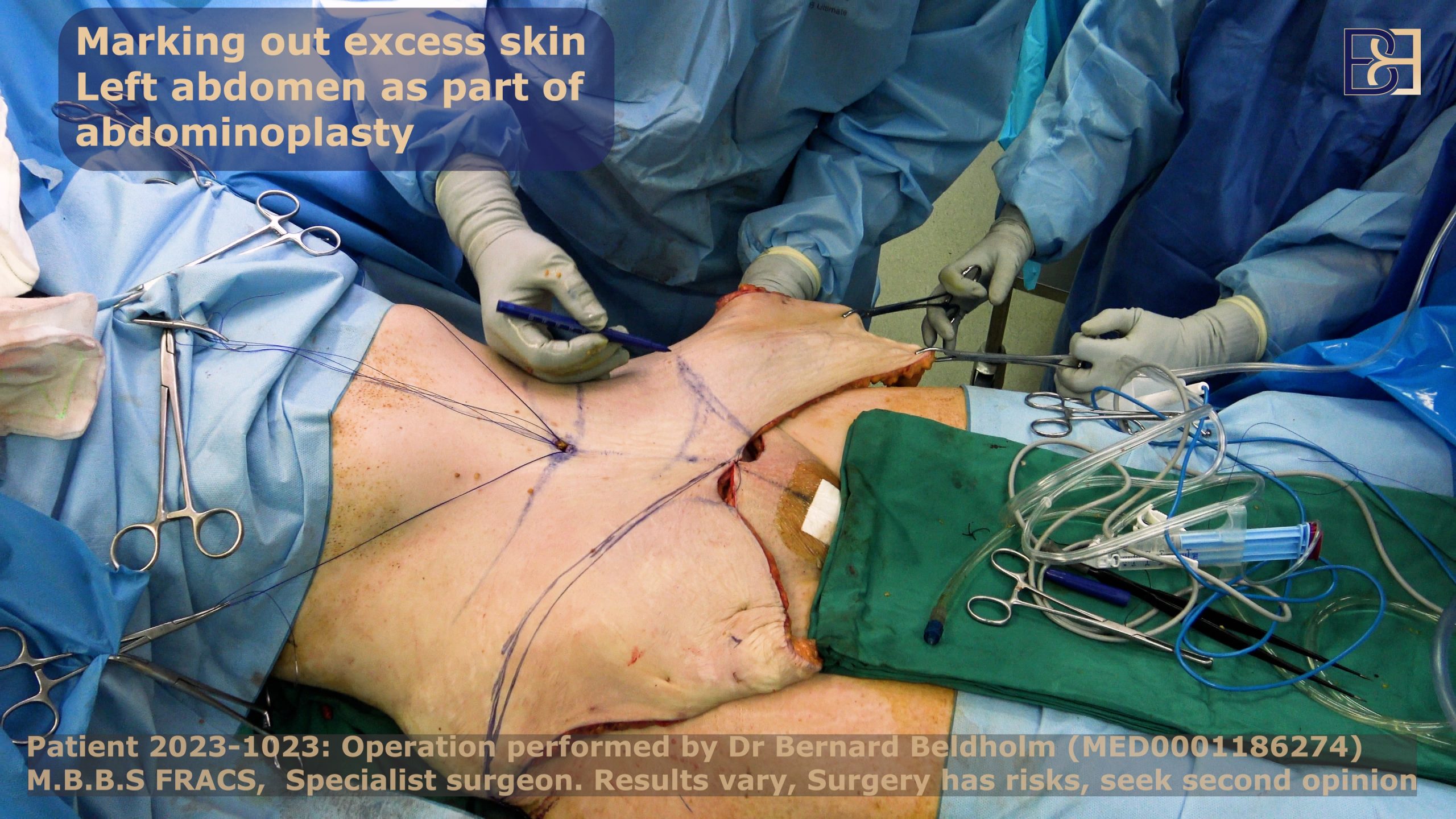 Marking out excess skin in lower abdomen