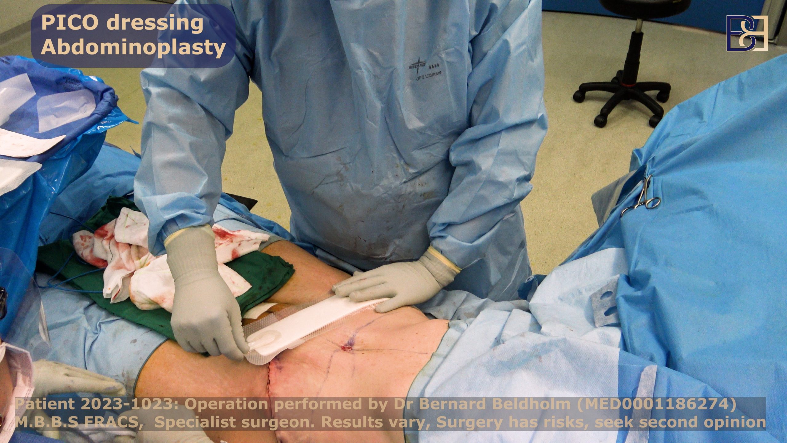 PICO dressings applied on the lower abdominal incision by Dr Bernard Beldholm