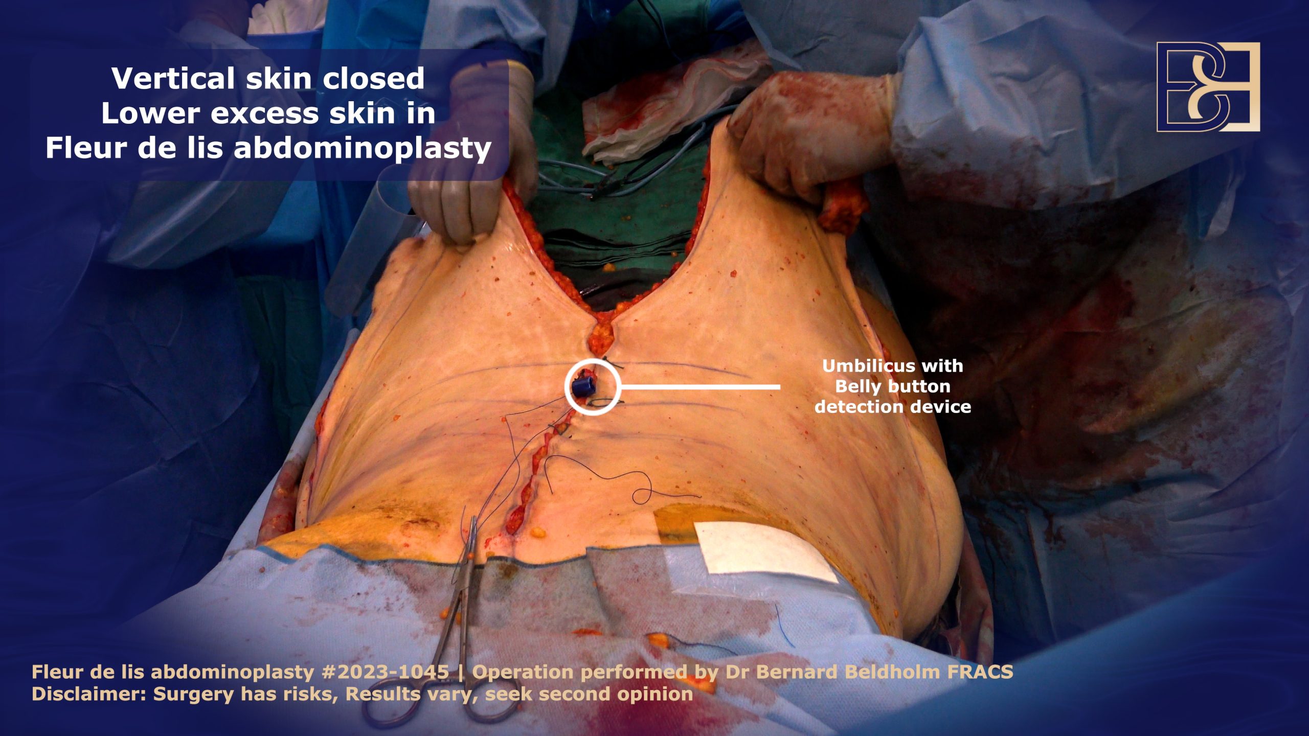 Umbilicus pulled though vertical incision  | Dr Bernard Beldholm