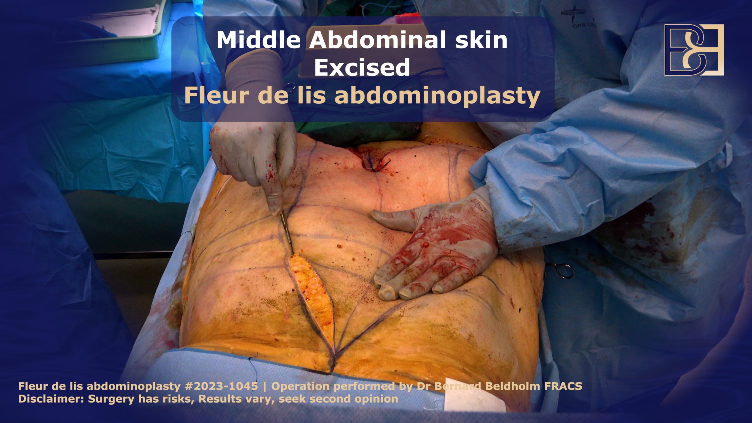 Initial incision in vertical skin for fleur de lis abdominoplasty | Dr Bernard Beldholm