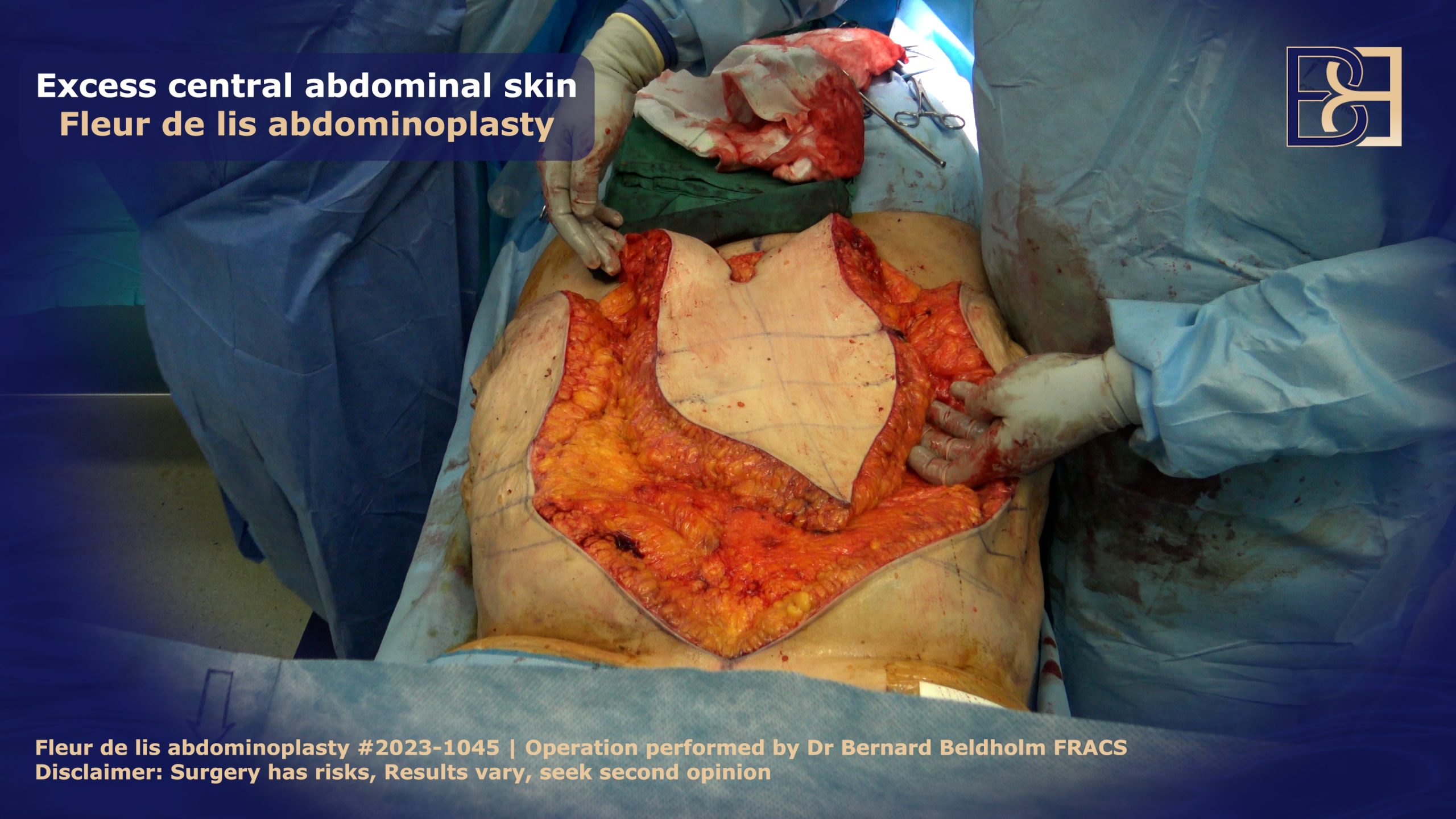 Excess skin in central abdomen removed as part of a fleur-de-lis abdominoplasty | Dr Bernard Beldholm