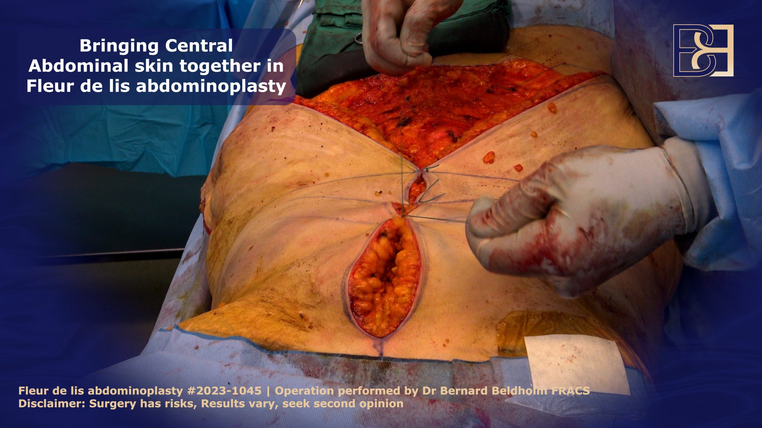 Bringing the central abdominal skin together in a fleur de lis abdominoplasty | Dr Bernard Beldholm