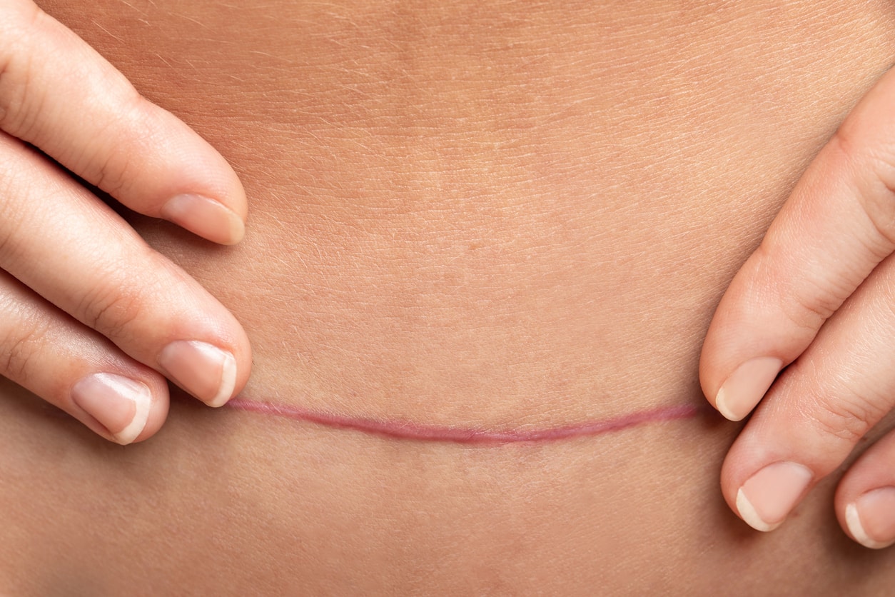 tummy tucks remove excess skin | Dr Bernard Beldholm