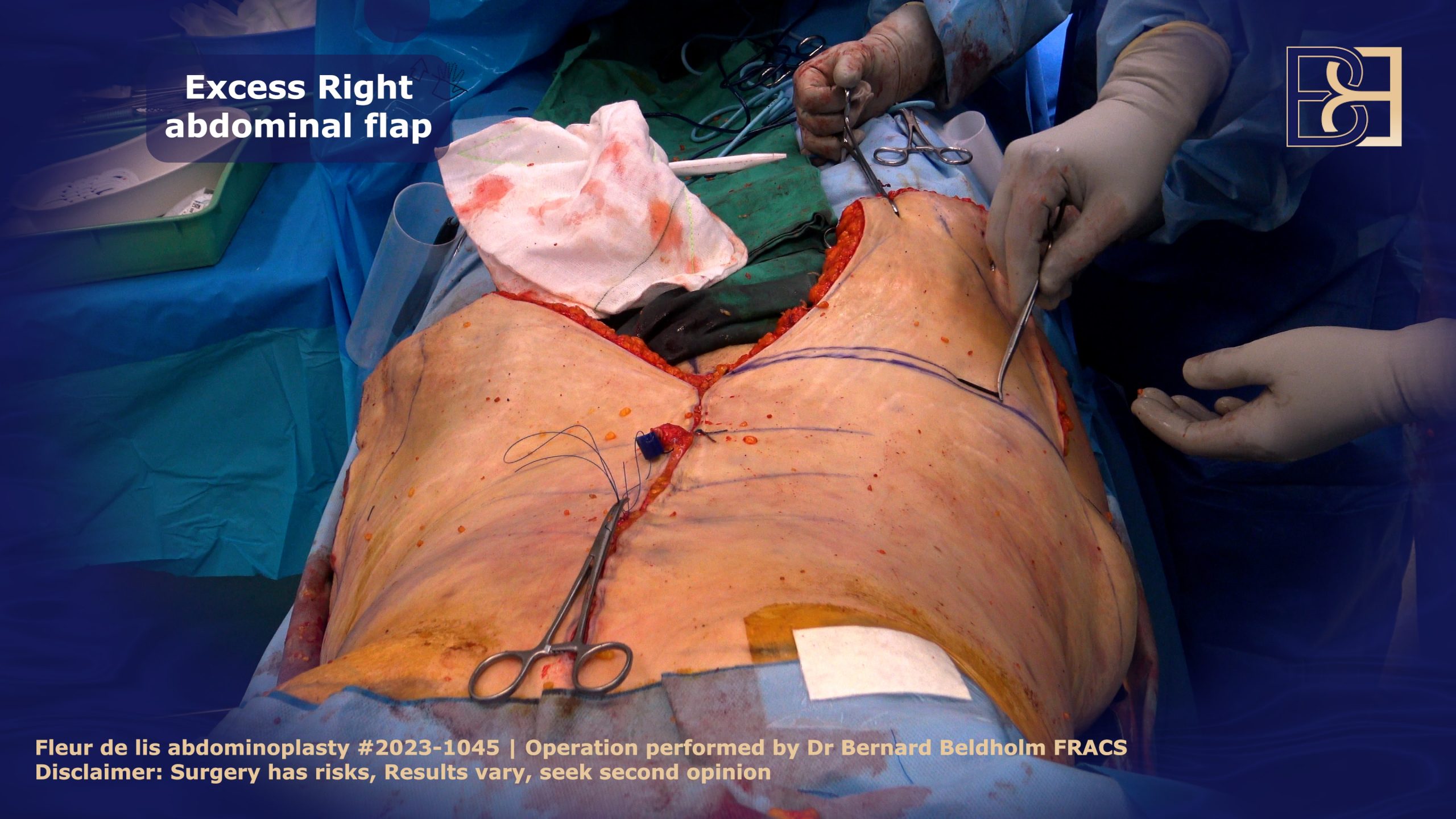 Excess Right abdominal flap in Fleur de lis abdominoplasty | Dr Bernard Beldholm