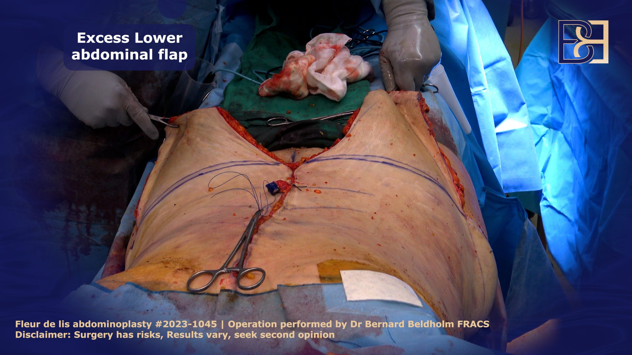 Comparing right and left side prior to removing excess lose skin in a fleur de lis abdominoplasty | Dr Bernard Beldholm