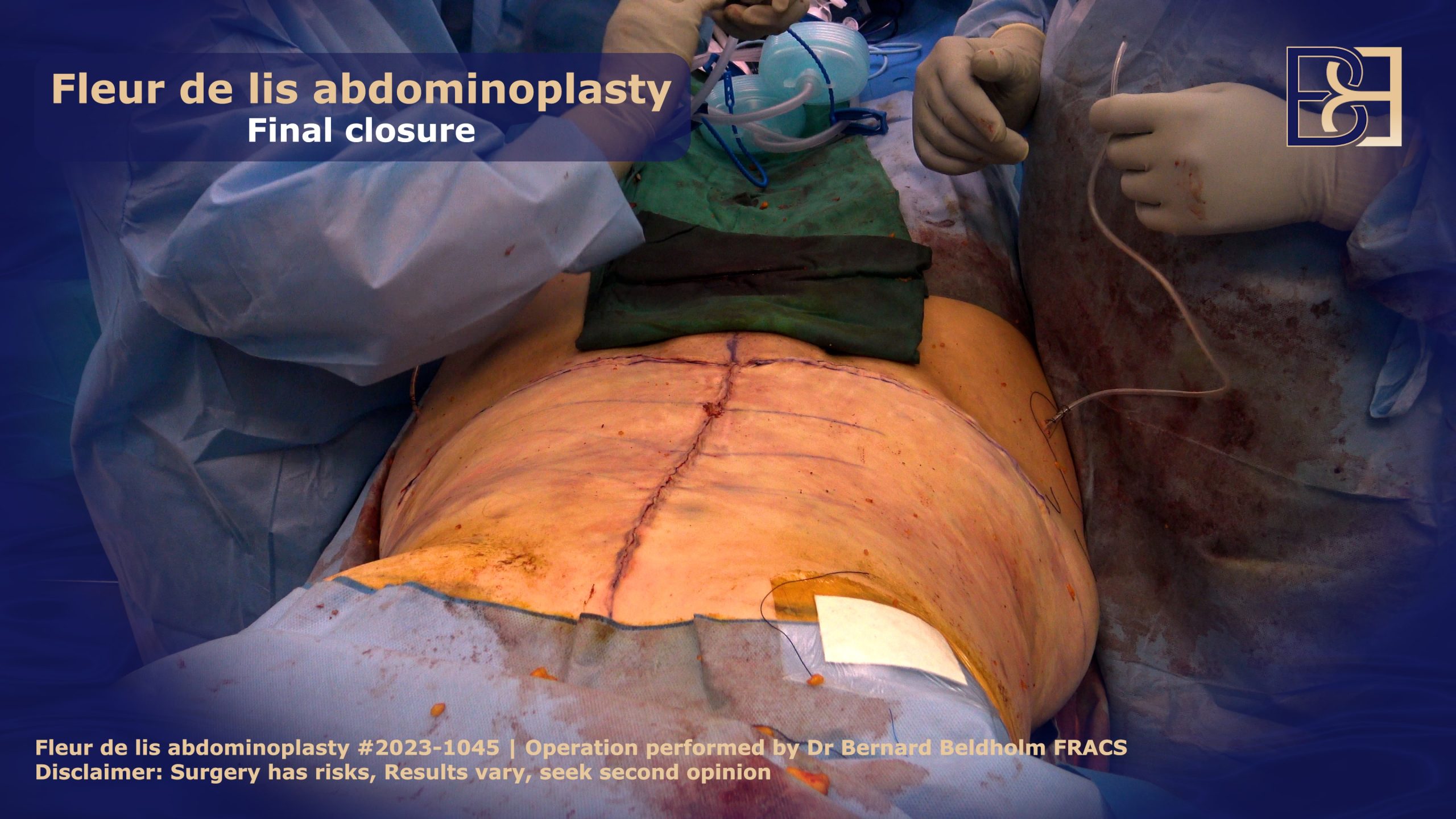 Fleud de lis abdominoplasty - Final closure | Dr Bernard Beldholm