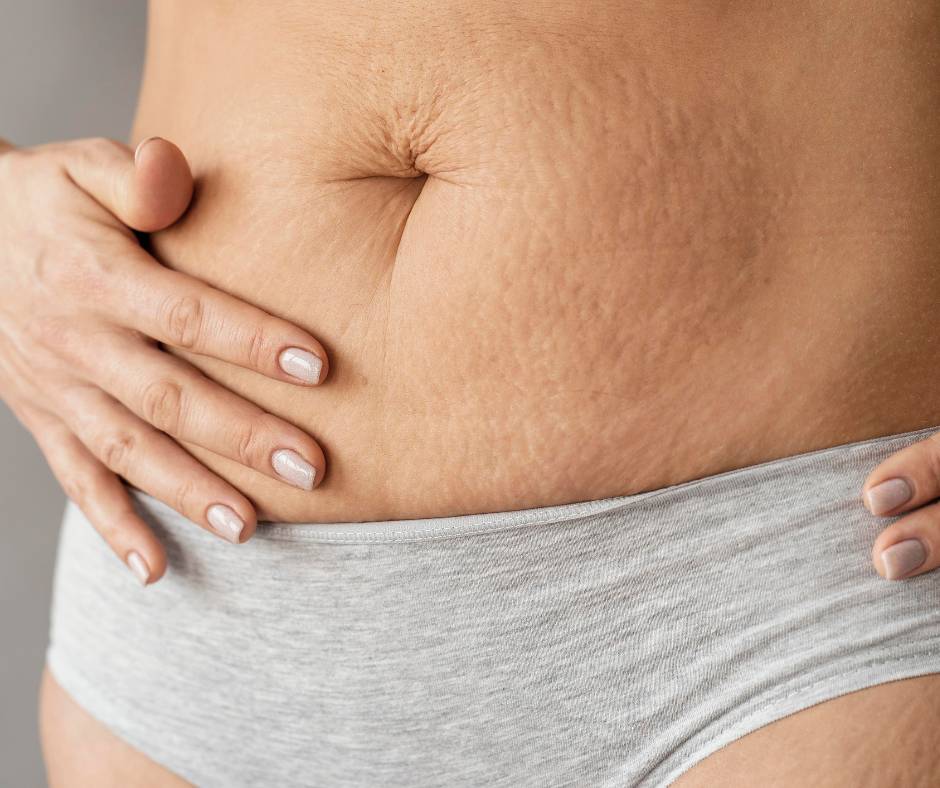 vaginal births and decreased risk of belly button distortion