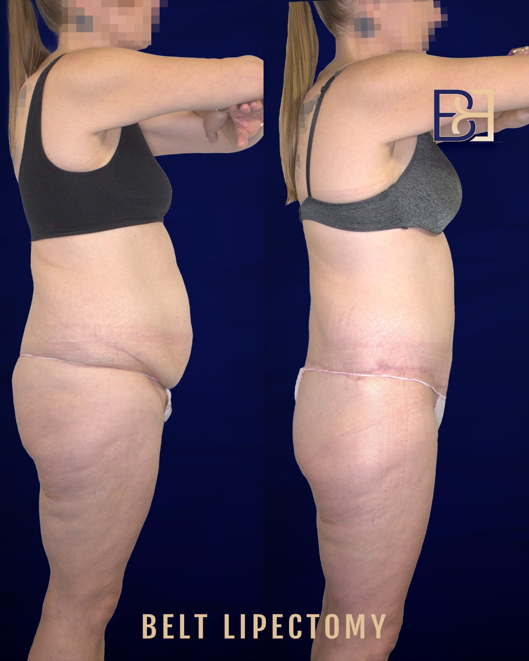 Before and After Belt Lipectomy Photos | Dr Bernard Beldholm