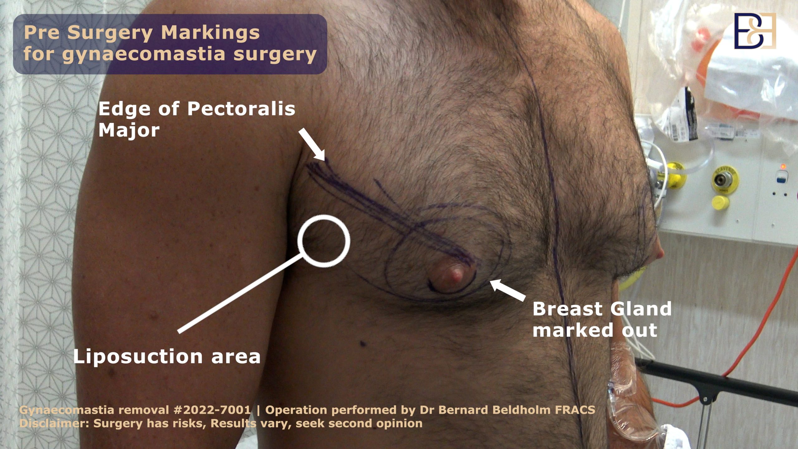 Pre-surgical markings of patient with gynaecomastia | Dr Beldholm