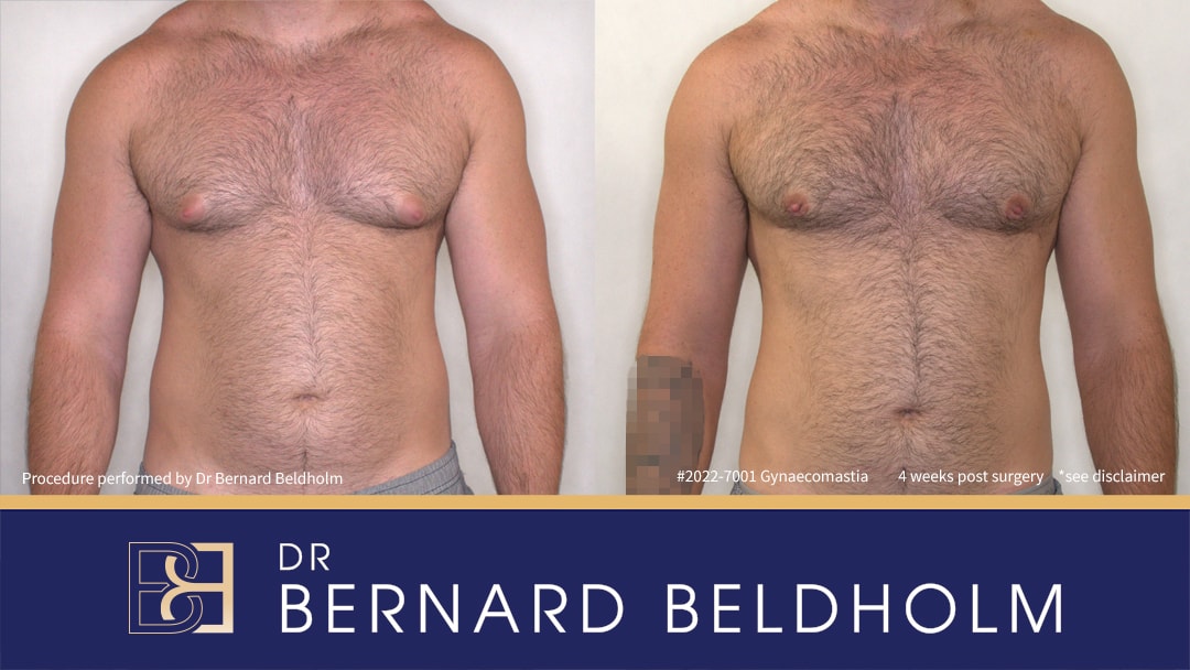 Before and after gynaecomastia surgery by Dr Bernard Beldholm