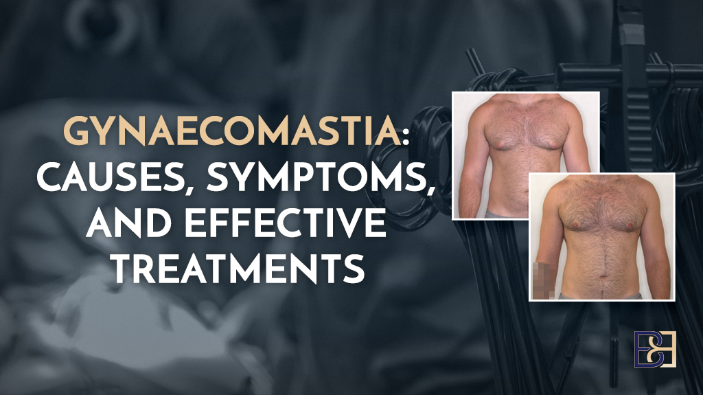 Gynaecomastia: Causes, Symptoms, and Effective Treatments