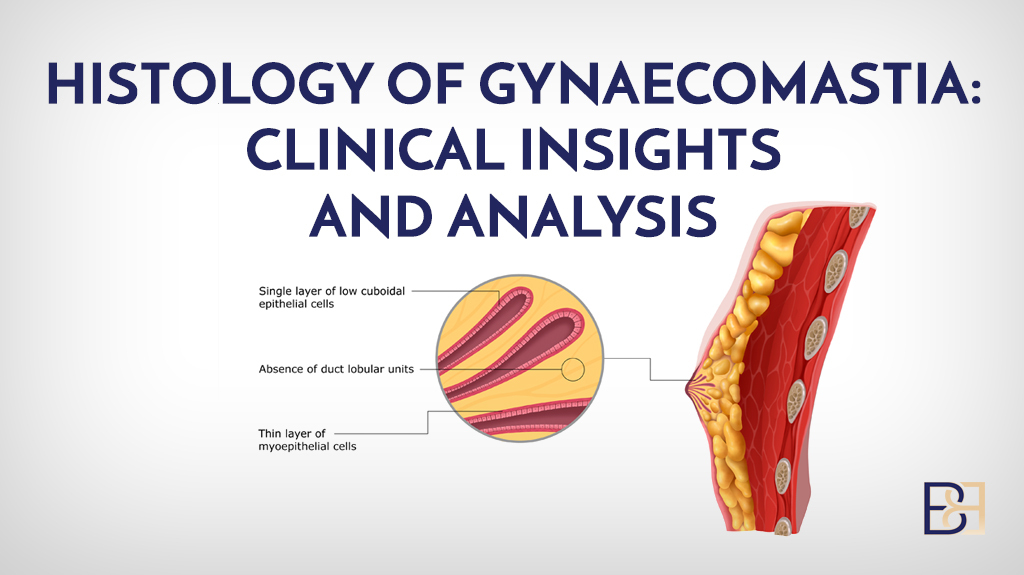 Histology of Gynaecomastia: Clinical Insights and Analysis