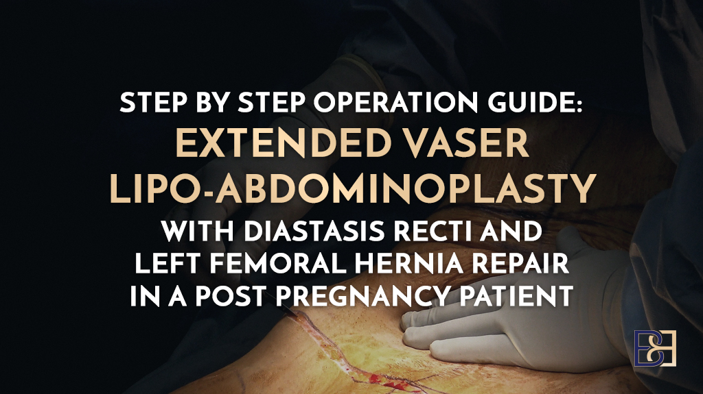 Step-by-Step Operation Guide: Extended VASER Lipo-Abdominoplasty with Diastasis Recti and Left Femoral Hernia Repair in a Post-Pregnancy Patient