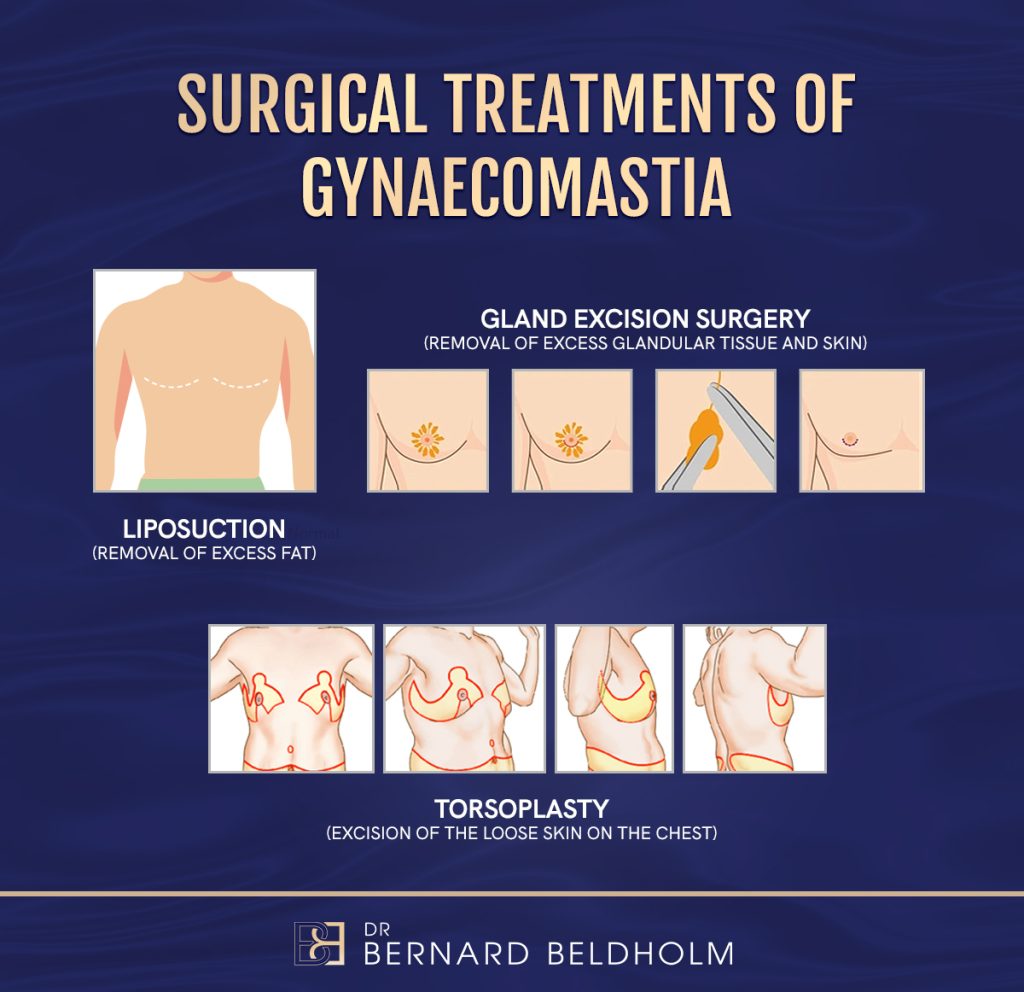 Essential Insights on Gynaecomastia Surgery for Men - Infographic