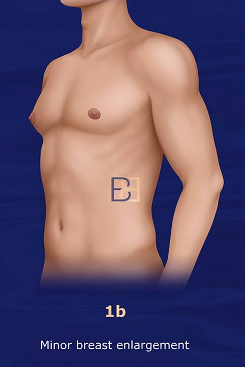 Grade 1b Minor Breast Enlargement