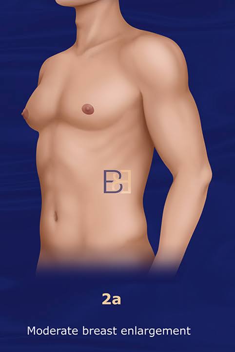 Grade 2a Moderate Enlargement Without Skin Excess